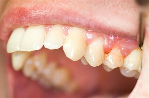 betennelse i tann hevelse